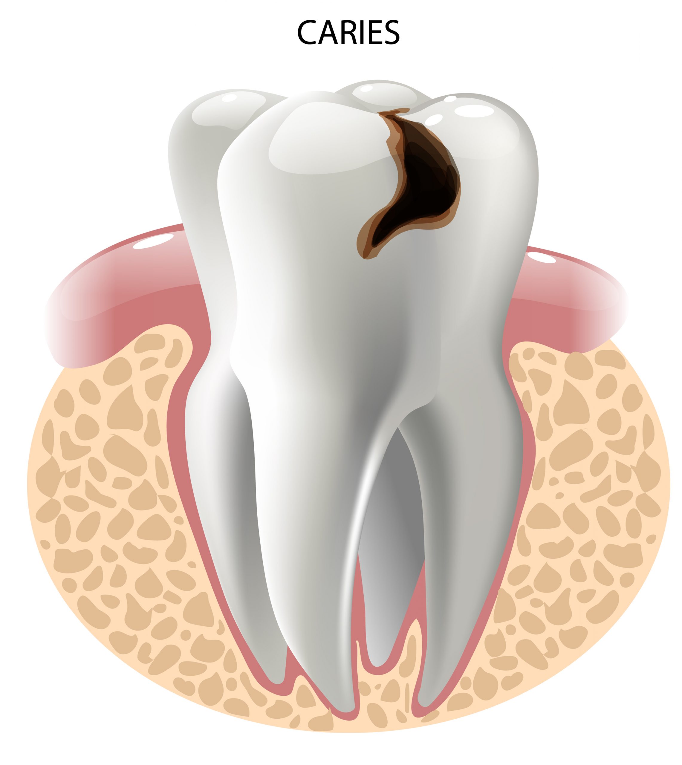 Qué son las caries dentales, causas y tratamientos