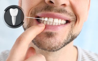 ¿Qué debes saber los implantes dentales?