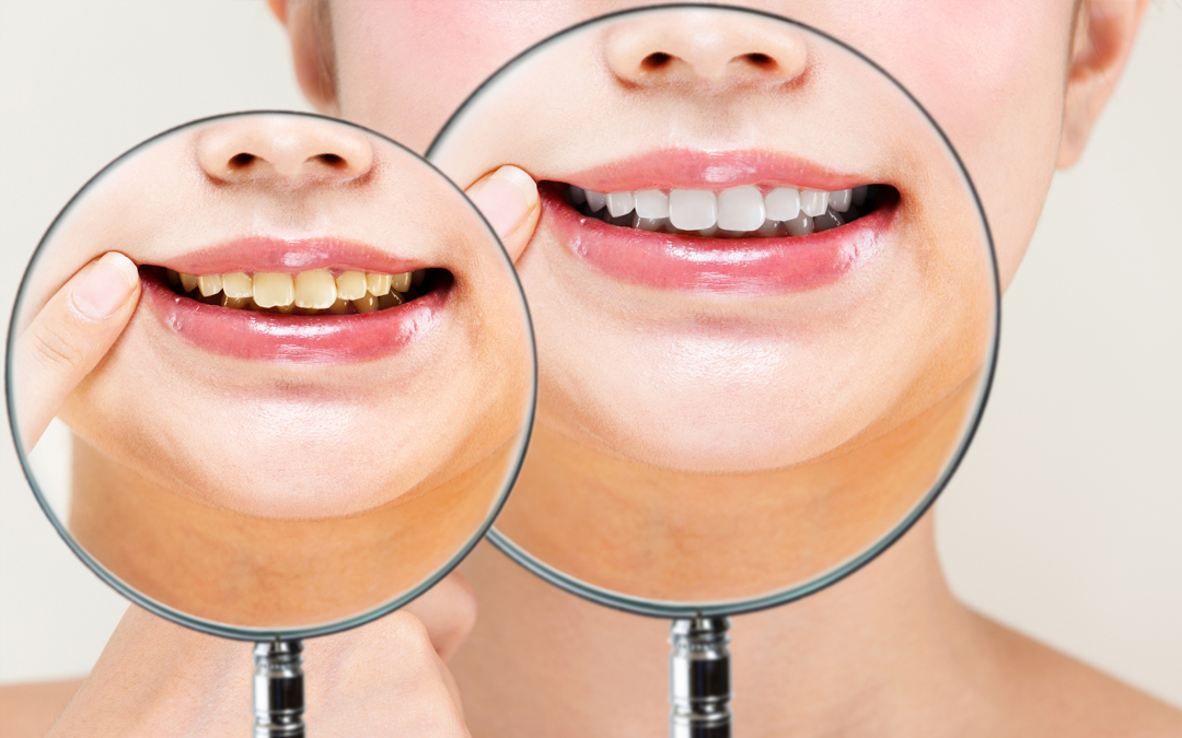 Blanqueamiento dental: causas y tipos