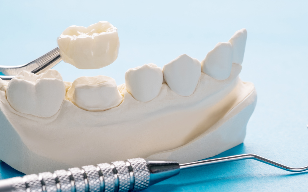 ¿Qué es una corona dental?