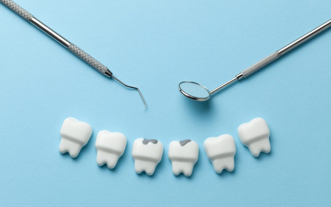 ¿Qué es una obturación dental?